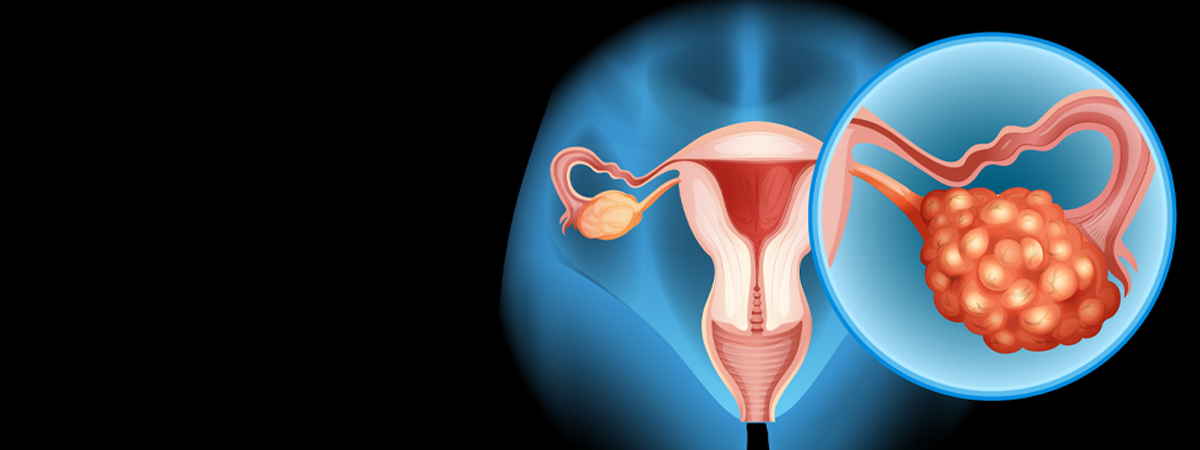 Cervical cancer treatment in Hyderabad | Dr. Madhu Devarasetty