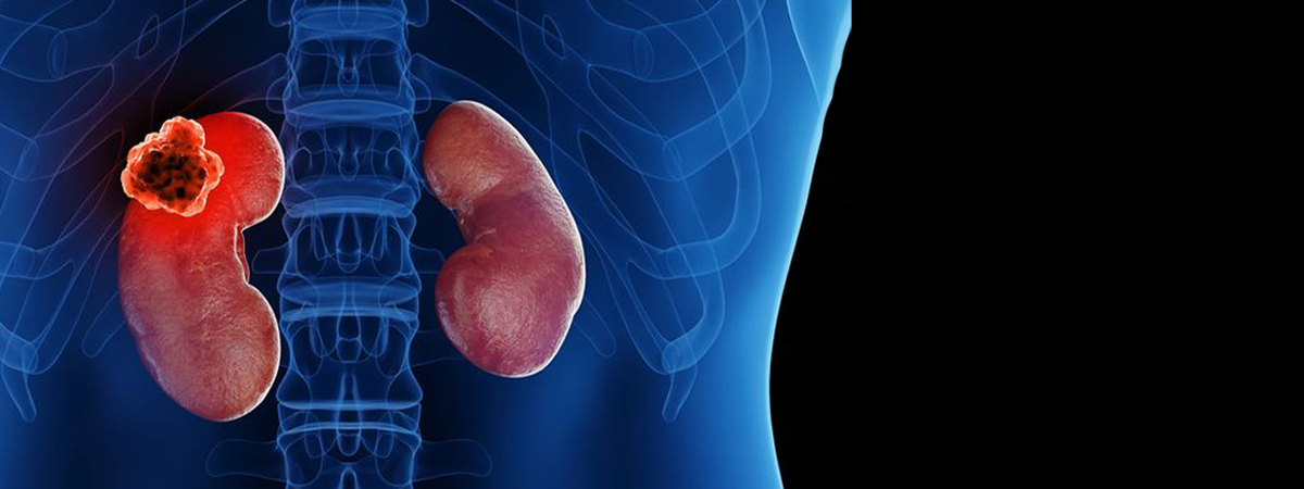 kidney cancer treatment in Hyderabad